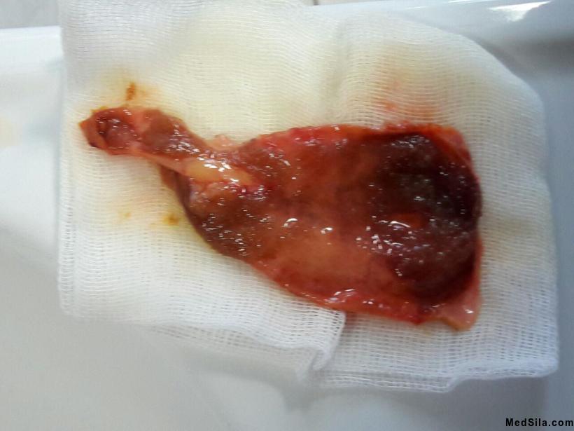 некалькулезный холецистит: желчный пузырь в разрезе